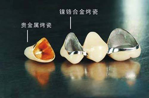 哪种烤瓷牙比较好