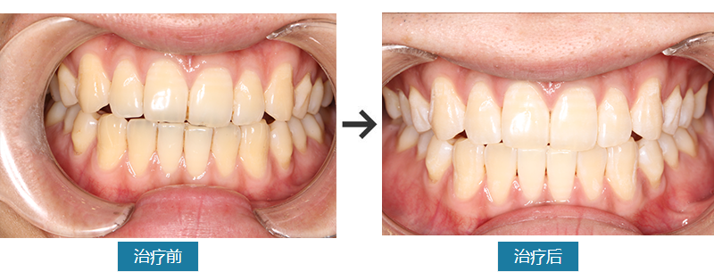 冷光美白，让牙齿白几度