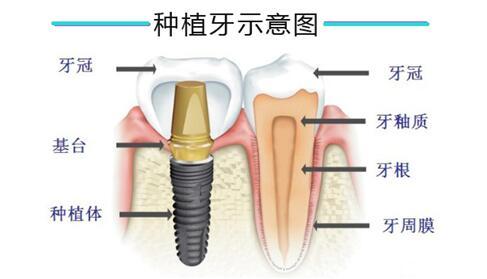 种植牙材料会不会对人体产生伤害