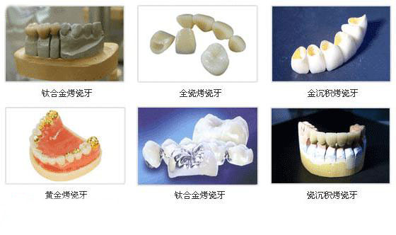 烤瓷牙的利与弊