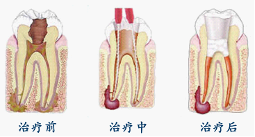 补牙