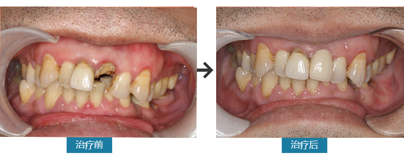 门牙烤瓷冠折断，全瓷冠修复棒棒哒